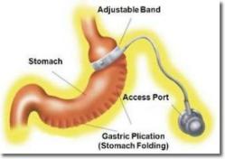 iBand gastric plication bariatric surrgery texas